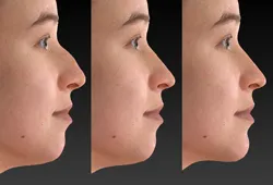 نتیجه اسکن سه بعدی بینی