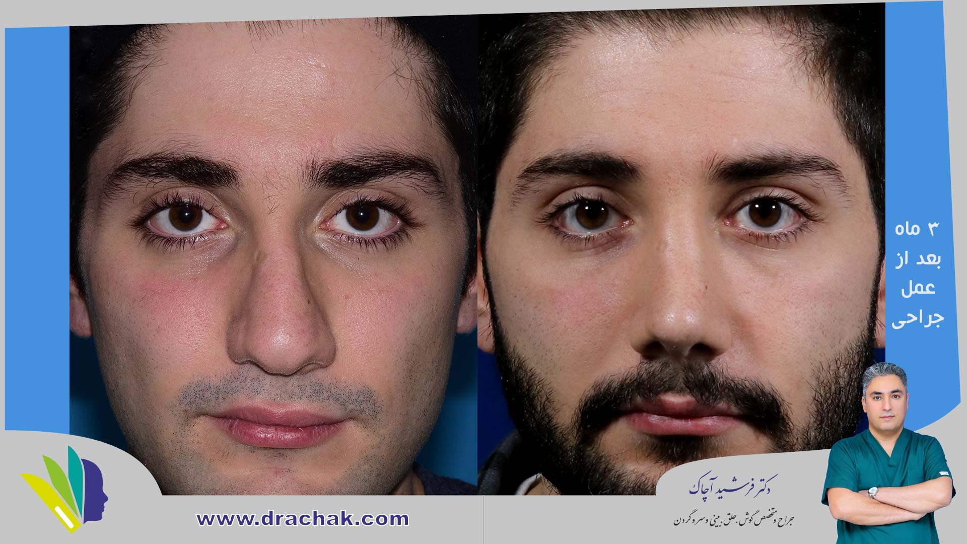 before after 10