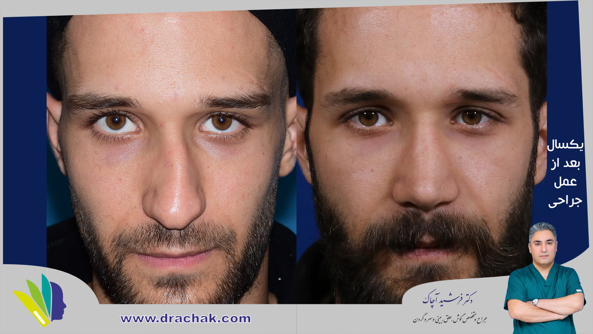 before after 4