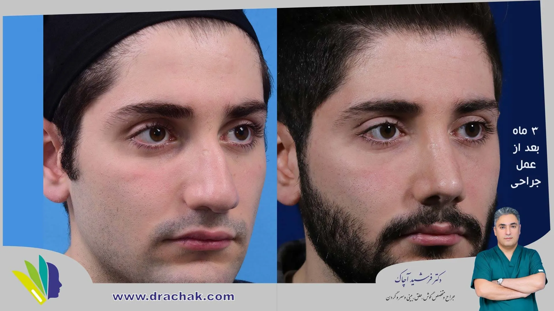 عمل بینی مردانه