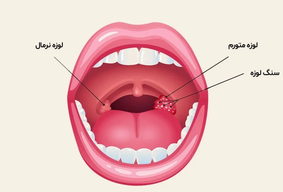 عمل لوزه کودکان